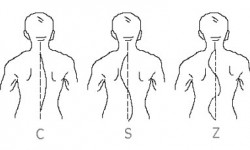 Пайдалуу кеңеш: Сколиозду дарылоого караганда алдын алуу жеңил (аудио)