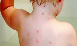 Чоң кишилер арасында суу чечек күчөдү