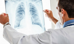 Өлкөдө пневмония болгондор былтыркыга караганда 24% көбөйдү