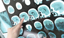 Бүгүнкү күндө инсультка кабылгандардын саны көбөйүүдө -  дарыгер Дариха Бакаева